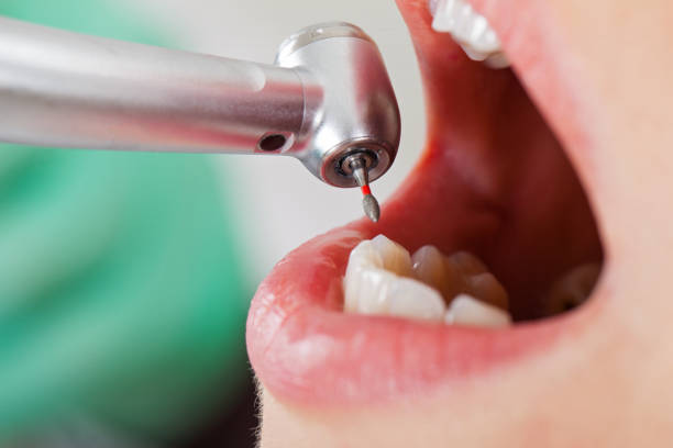 Best Chipped Tooth Repair Near Me  in Hopewell, TN